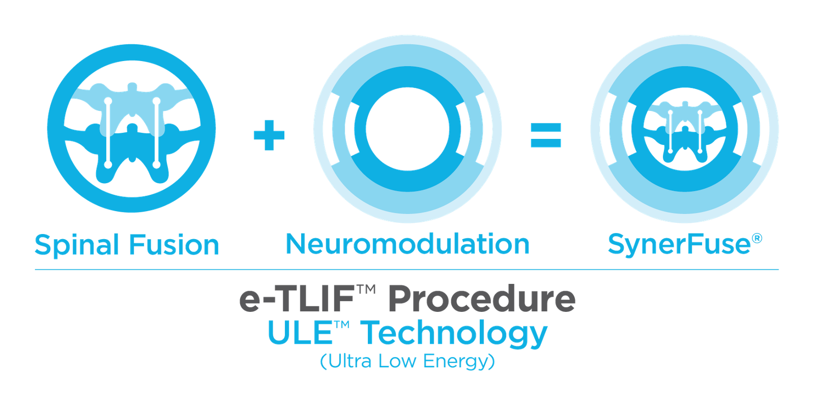 Diagram of the e-TLIF procedure: a lumbar interbody fusion with a stimulation lead placed at the dorsal root ganglion on the same spinal level, connected to an implanted pulse generator.